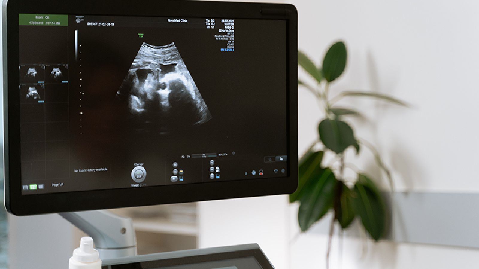 Tidlig ultralyd - fosterdiagnostistikk